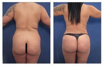 BBL Shape Change With Aging