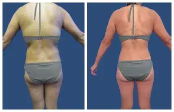 Before and after pictures of a woman's tummy tuck.