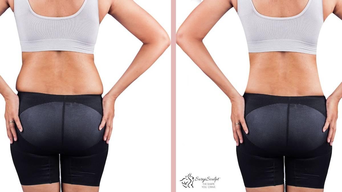 Two pictures of a woman in a pair of black shorts, liposuction.