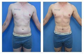 How Much Tumescent Volume can be used During Liposuction