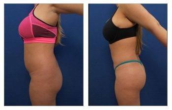 How To Avoid Fat Emboli Following BBL