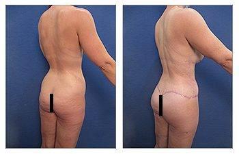How to Correct Butt Cellulite