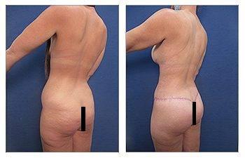 How to Correct Butt Cellulite