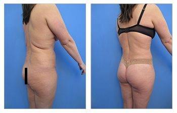 Breast Implant Augmentation After Breast Lift — patient photo