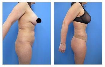 Tummy Tuck Alternatives — patient photo