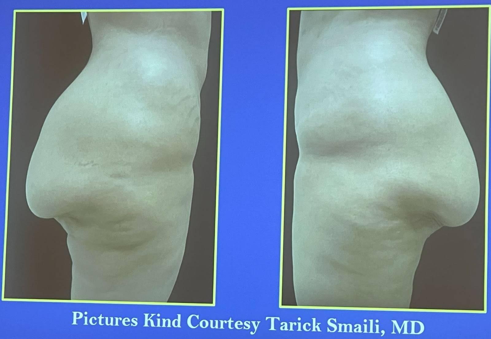 fix a sagging butt