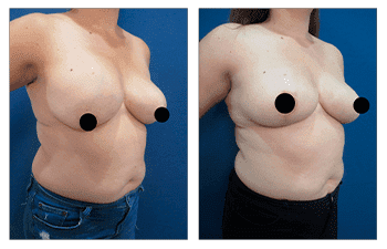 A woman's breast before and after surgery for breast herniation.