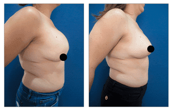 A woman's breast before and after surgery, including tips on how to fix poor areola scarring after a breast lift.