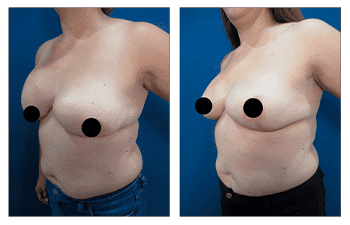 A woman's breast before and after surgery to fix breast herniation.
