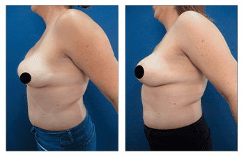 A woman's breast before and after surgery for breast herniation.