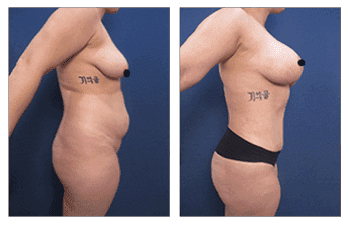 How to Fix the Lower Abdominal Bulge