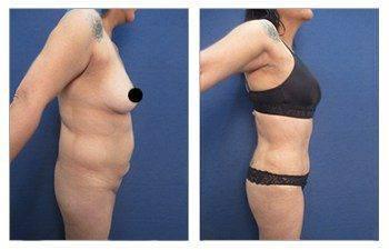 Liposuction - How to Get an Innie Belly Button with a Tummy Tuck