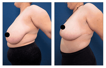 A woman with tattoos on her breast before and after undergoing breast surgery for fixing poor areola scarring post-breast lift.