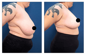 A woman's breast before and after surgery for breast reduction.