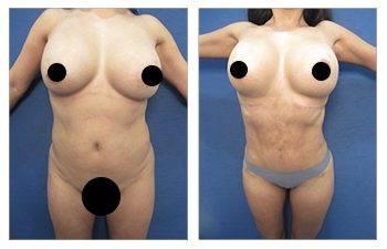 How to Maximize Waistline Narrowing