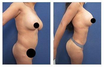 How to Maximize Waistline Narrowing