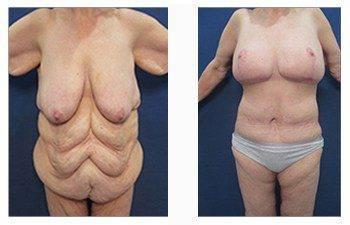 post bariatric front view