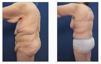 post bariatric back left view