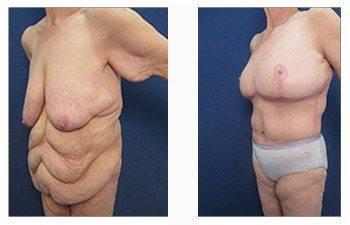 post bariatric front left view