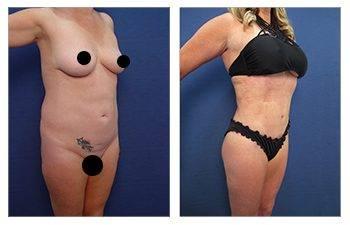 Ideal Belly Button Shape With Tummy Tuck