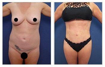 Ideal Belly Button Shape With Tummy Tuck