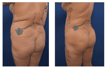 Ideal Treatment Of Lipedema