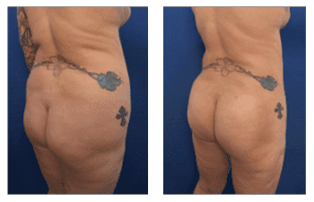 Ideal Treatment Of Lipedema