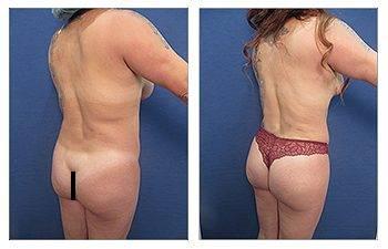 Airsculpt BBL Before and After