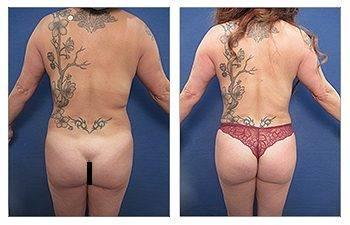 Airsculpt BBL Before and After