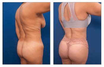 Smart Lipo - Laser lipo vs VASER lipo