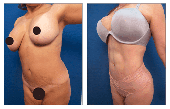 smart-lipo-vs-vaser-(4)