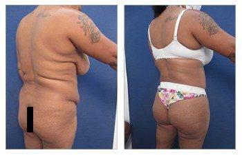 Transform your figure with a tummy tuck before and after, targeting the pesky lateral hip dip for a smoother silhouette. Say goodbye to stubborn love handles and hello to confid…