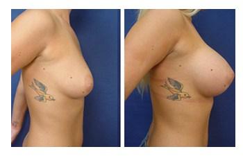 Breast Augmentation Revision to Go Bigger before and after — view 5