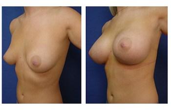 Breast Augmentation Revision to Go Bigger before and after — view 3
