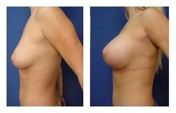 Breast Augmentation Revision to Go Bigger before and after — view 4