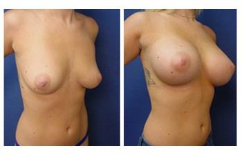 Breast Augmentation Revision to Go Bigger before and after — view 2