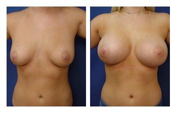 Breast Augmentation Revision to Go Bigger before and after — view 1