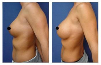 Breast Augmentation Revision to Go Bigger before and after — view 2