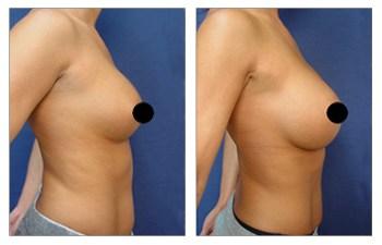 Breast Augmentation Revision to Go Bigger before and after — view 3