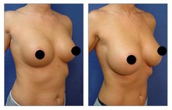 Breast Augmentation Revision to Go Bigger before and after — view 5