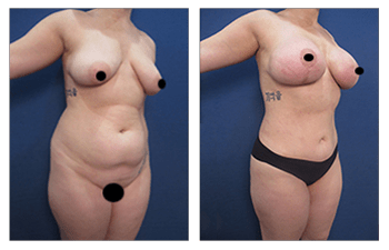 Mommy Makeover before and after — view 2