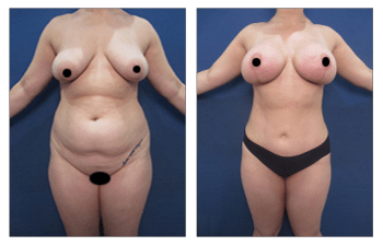 Mommy Makeover before and after — view 1