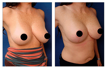 Breast Lift with Implants before and after — view 4
