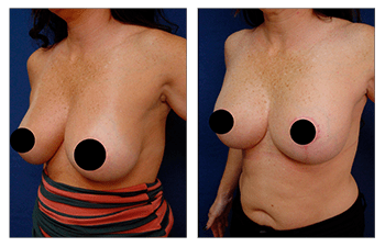 Breast Lift with Implants before and after — view 5