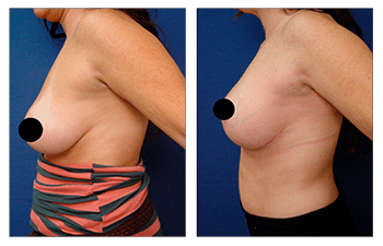 Breast Lift with Implants before and after — view 3