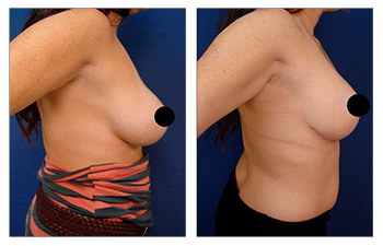 Breast Lift with Implants before and after — view 2
