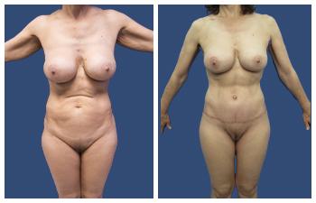 Mini Tummy Tuck — #SS363