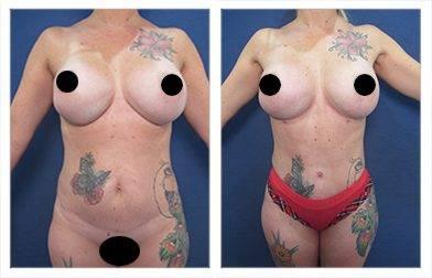 Liposuction Complications