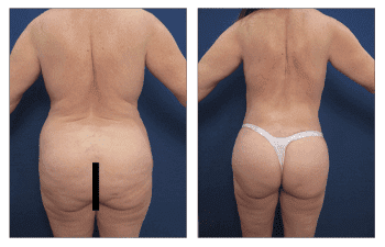Liposuction Revision Newport Beach