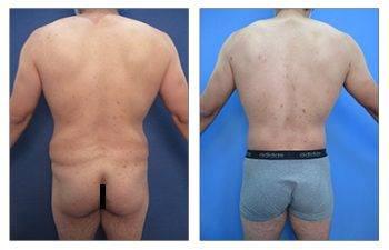 Male Brazilian Butt Lift